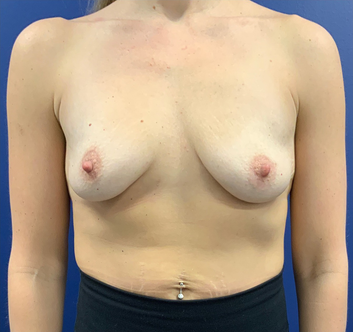 Breast-Augmentation-Case--20570 | Before Breast 1