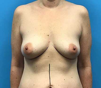 Case--96 | Before Breast 1