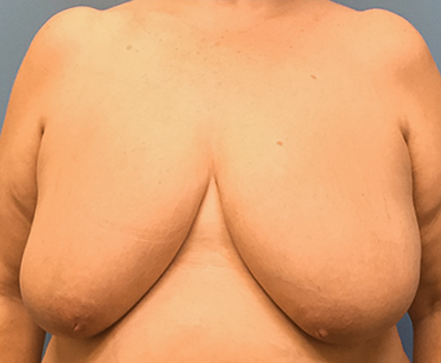 Breast-Reduction-Case--130 | Before Breast 1