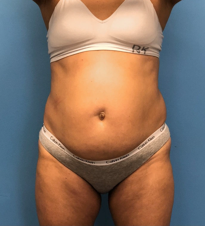 Case--14819 | Before Tummy Tuck 1