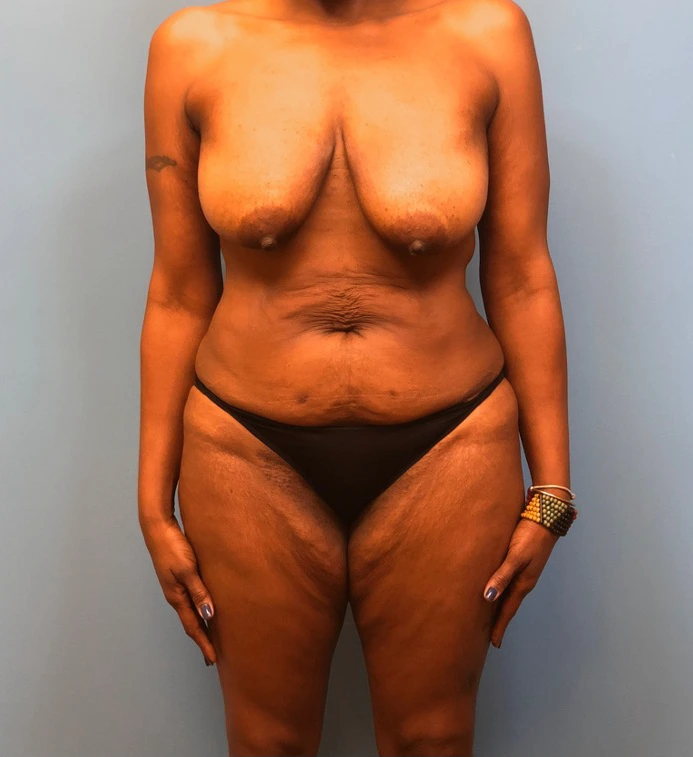Mommy-Makeover-Case--13869 | Before Mommy Makeover 1