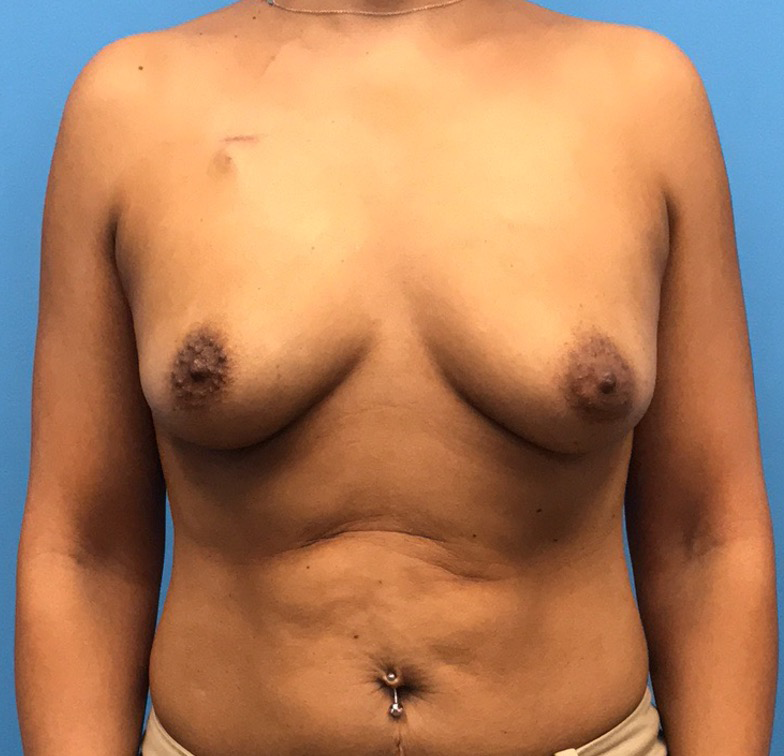 Case--11132 | Before Breast 1