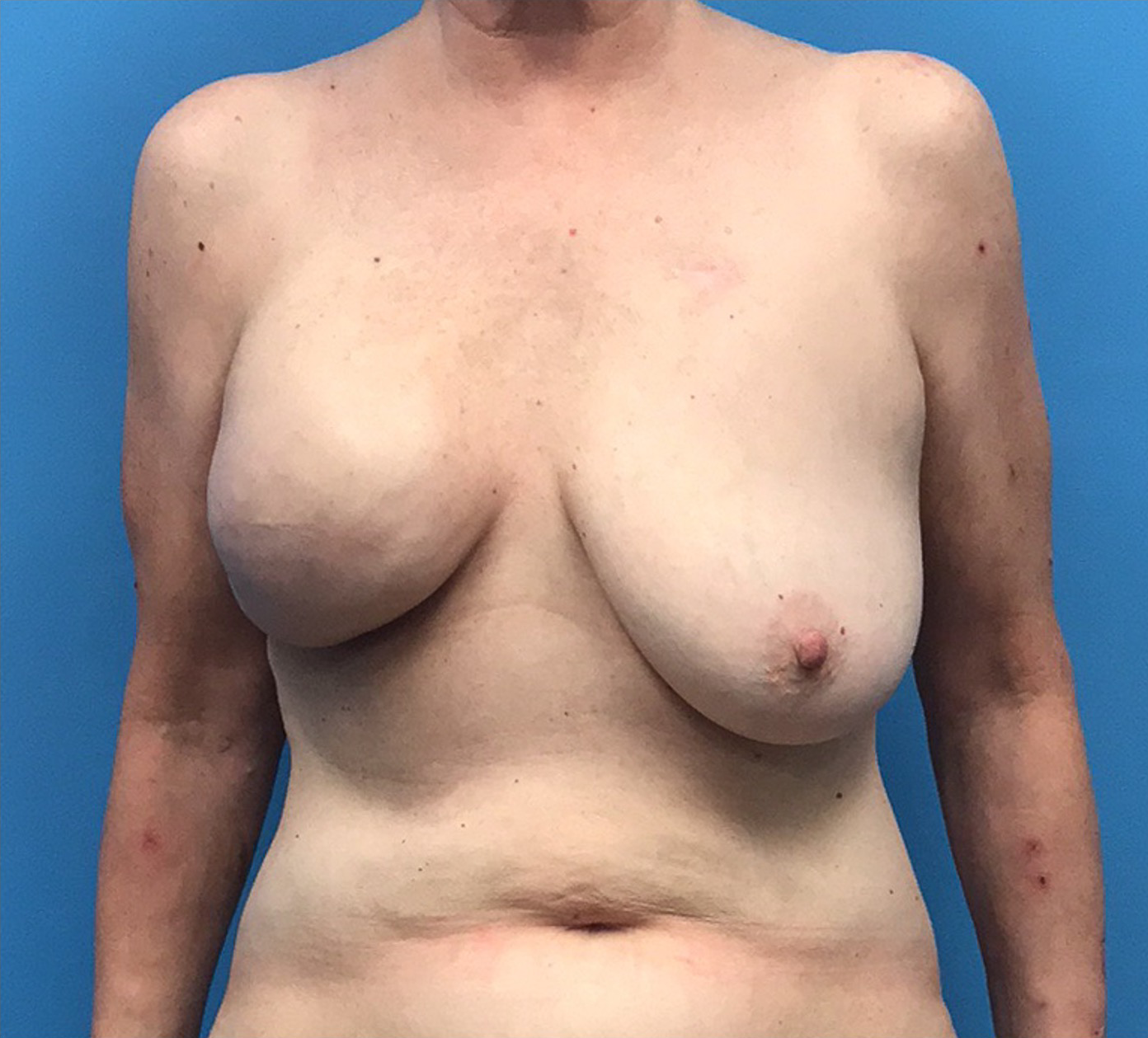 Case--10040 | Before Breast 1