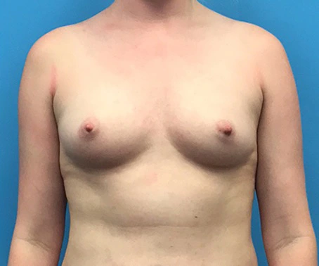Case--94 | Before Breast 1