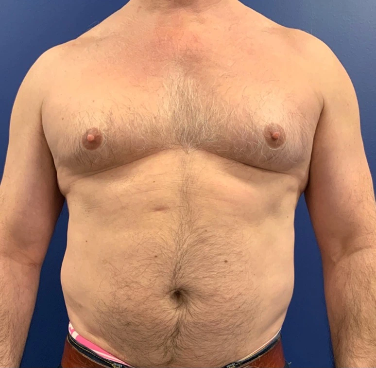 Gynecomastia-Case--20376 | Before Breast 1
