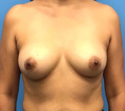 Case--134 | Before Breast 1
