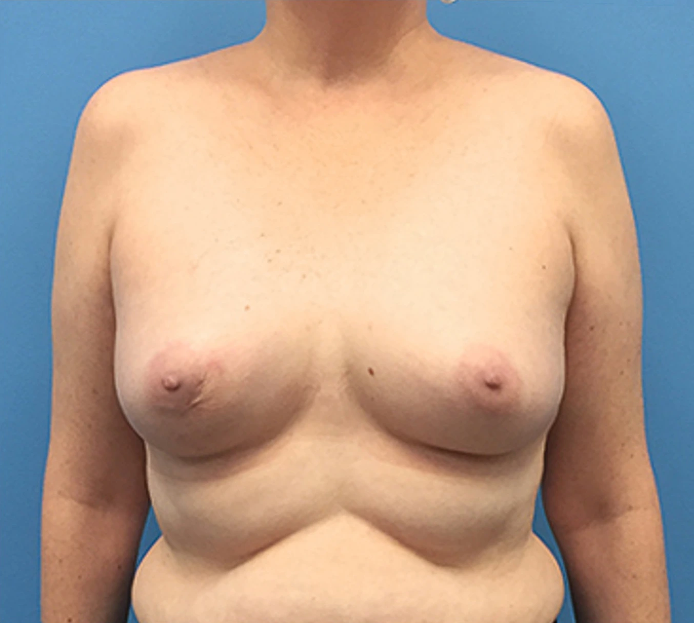 Case--135 | Before Breast 1