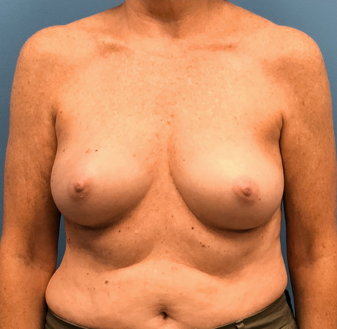 Case--13861 | Before Breast 1