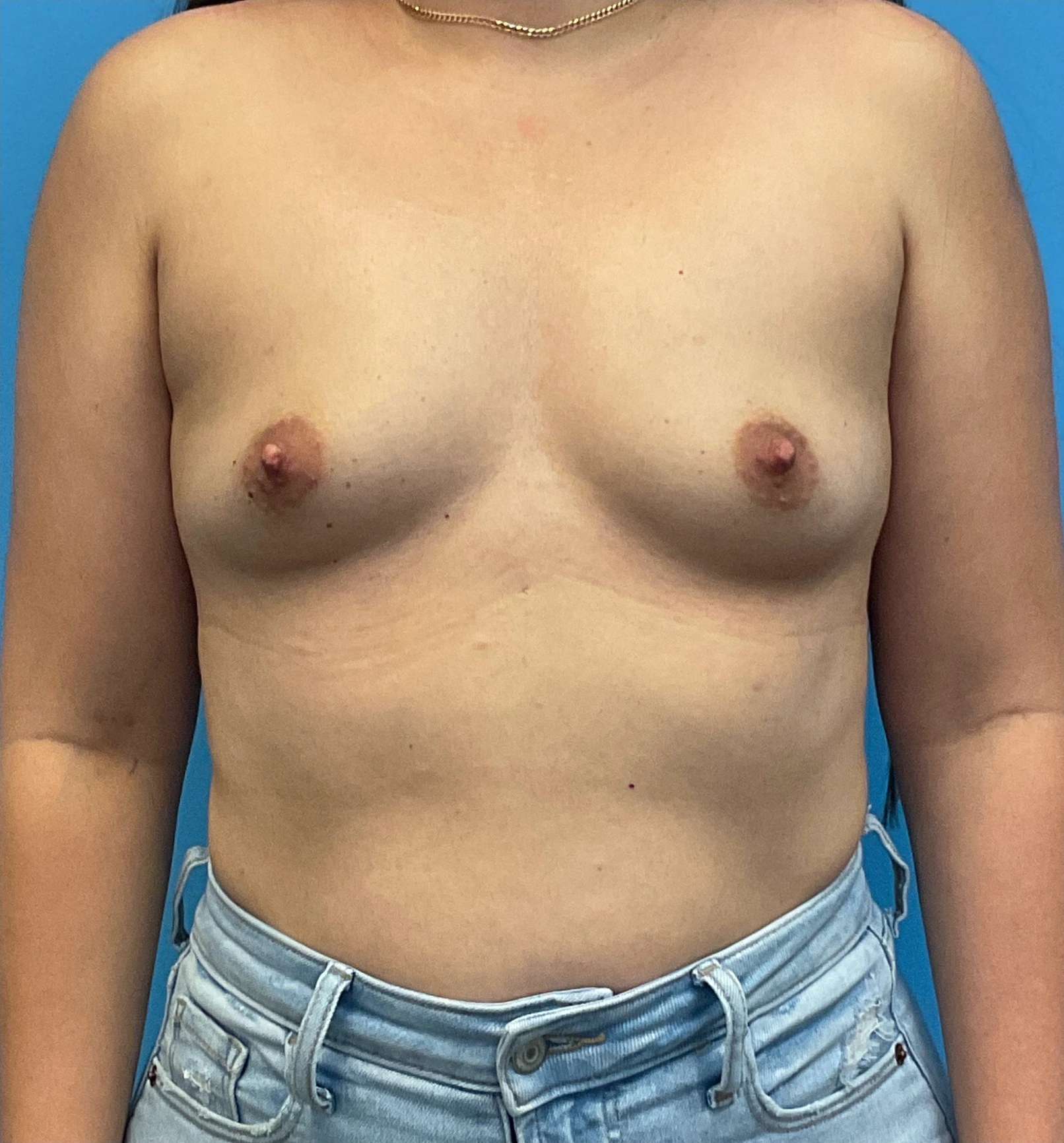 Breast-Augmentation-Case--25743 | Before Breast 1