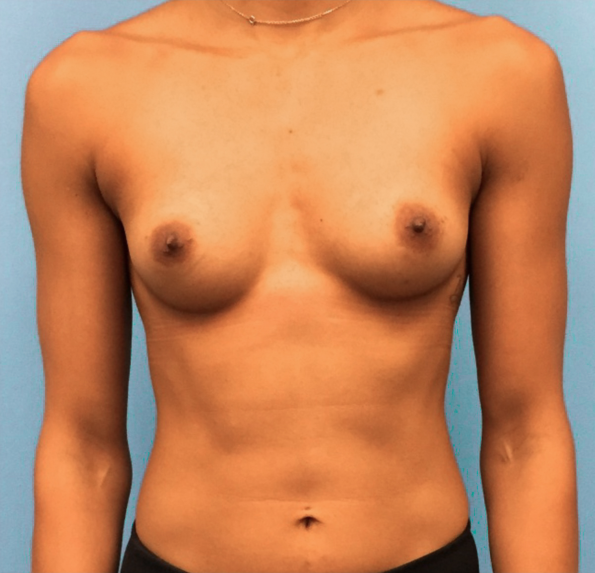 Breast-Augmentation-Case--221 | Before Breast 1