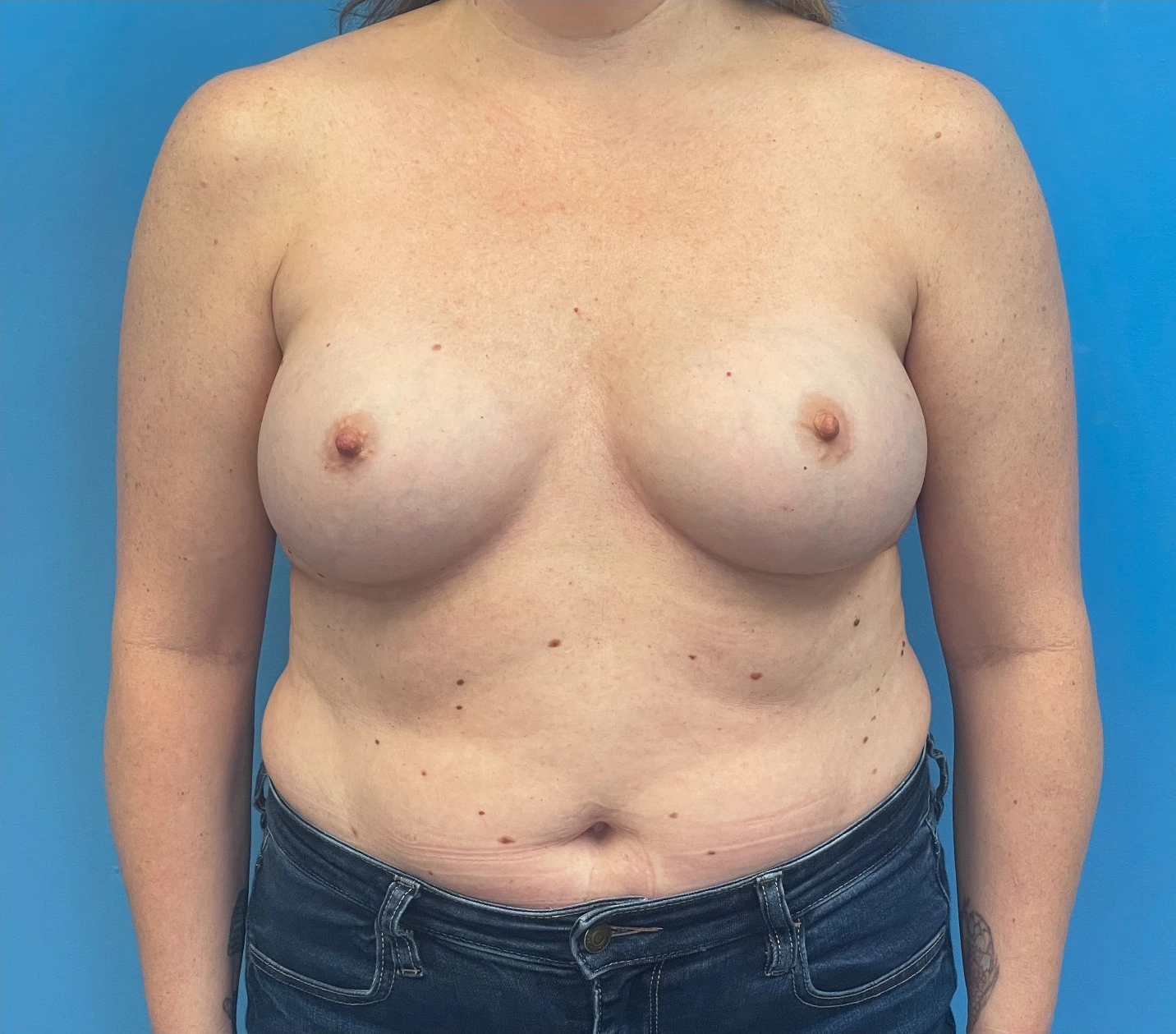 Breast-Reconstruction-Case--27065 | Before Breast 1