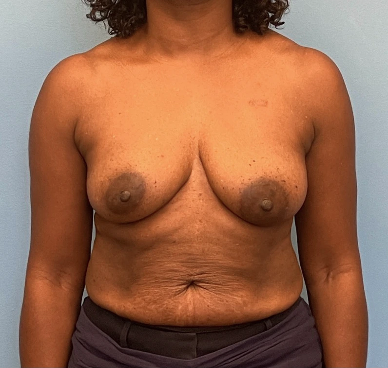 Breast-Reconstruction-Case--23930 | Before Breast 1