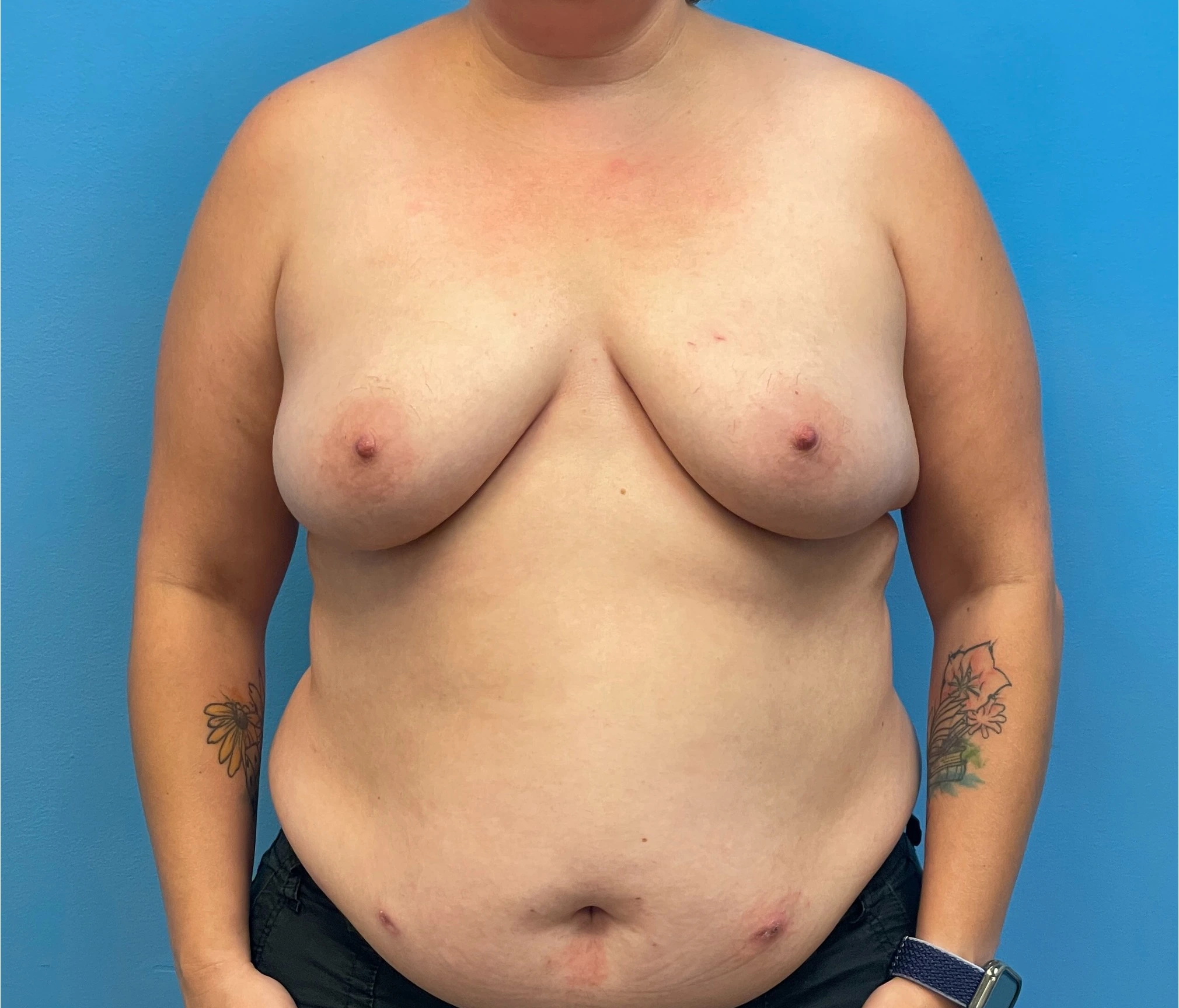 DIEP-Flap-Case--28021 | Before Breast 1
