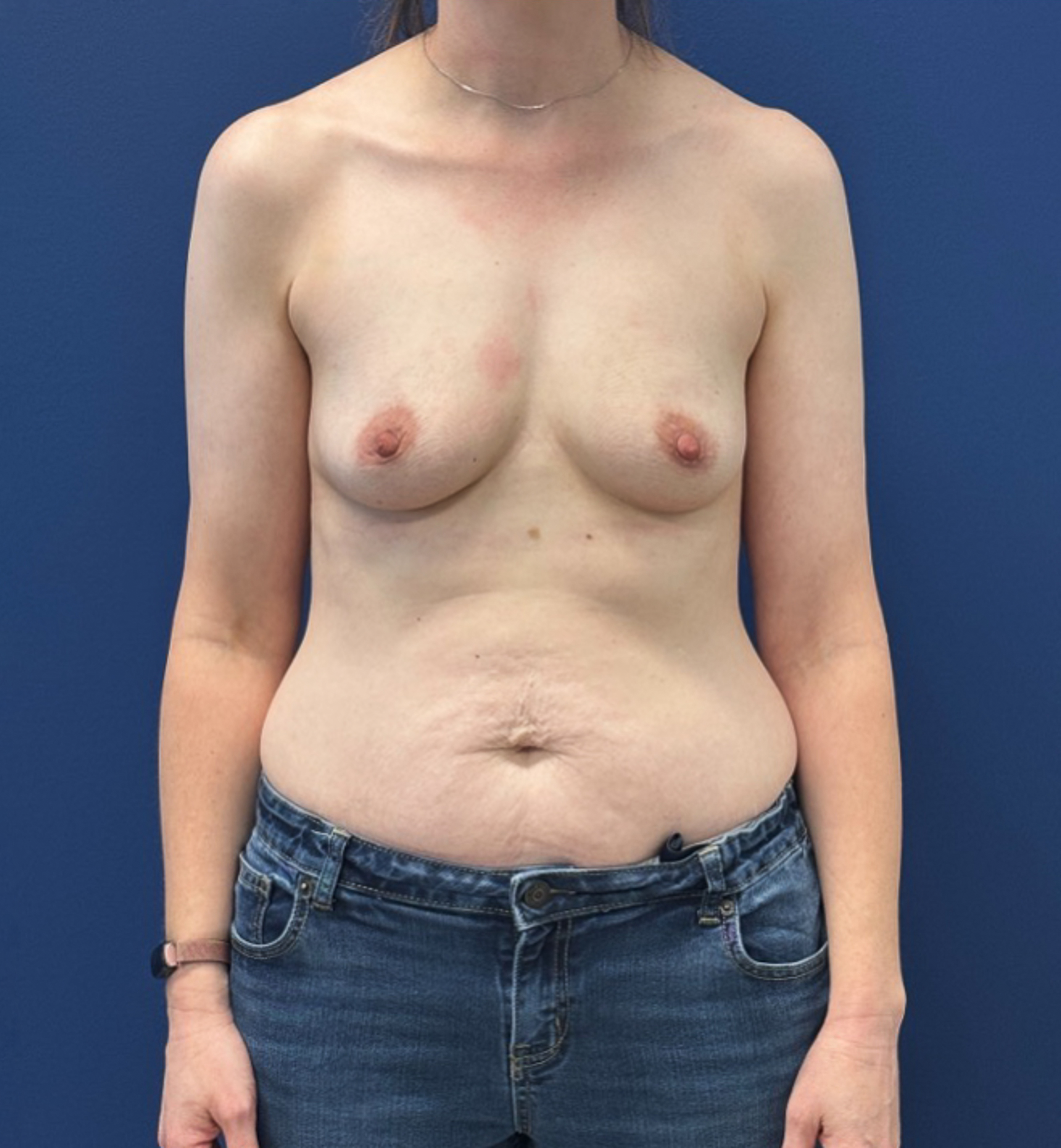 Breast-Augmentation-Case--28670 | Before Breast 1