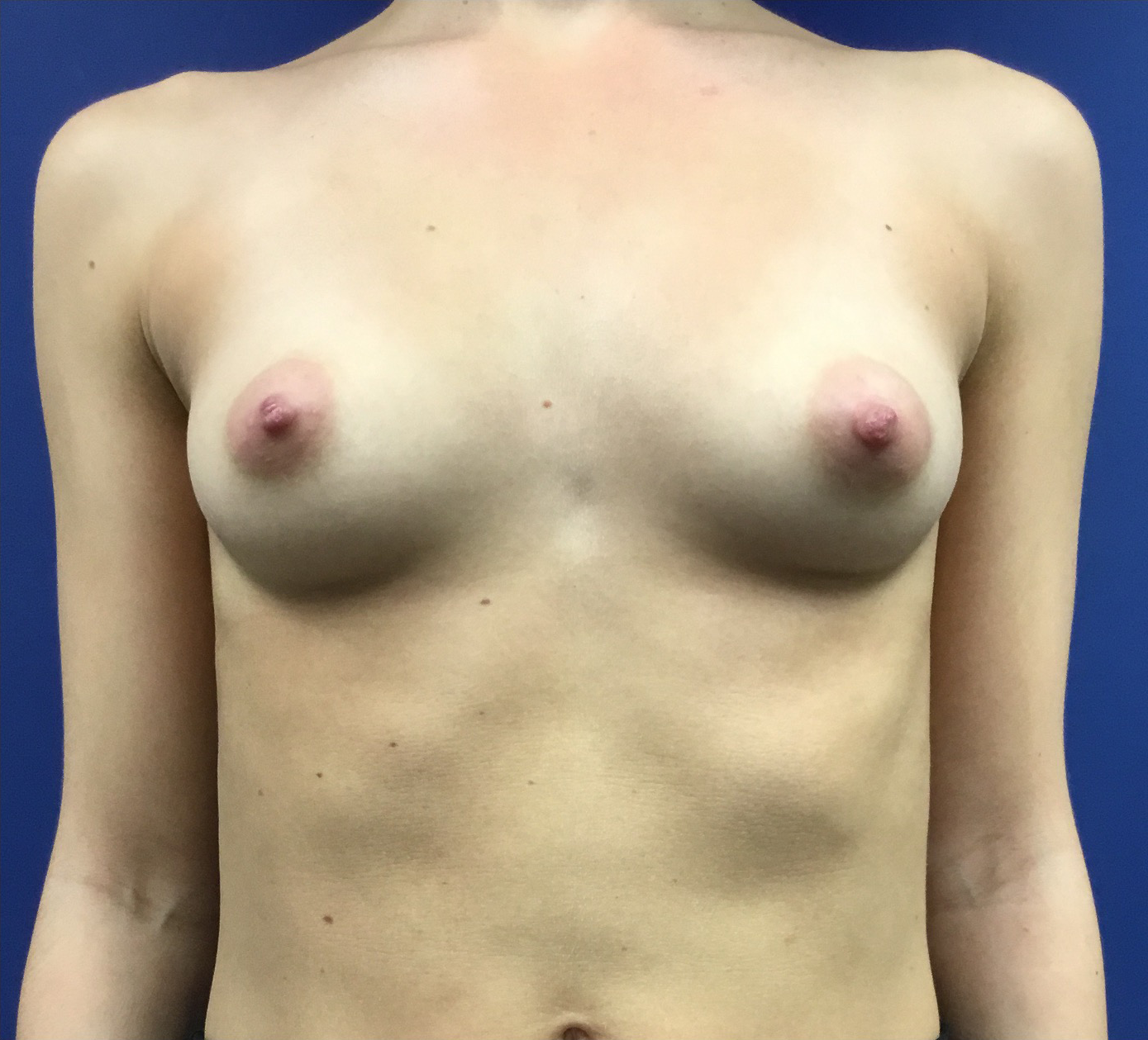 Breast-Augmentation-Case--19360 | Before Breast 1