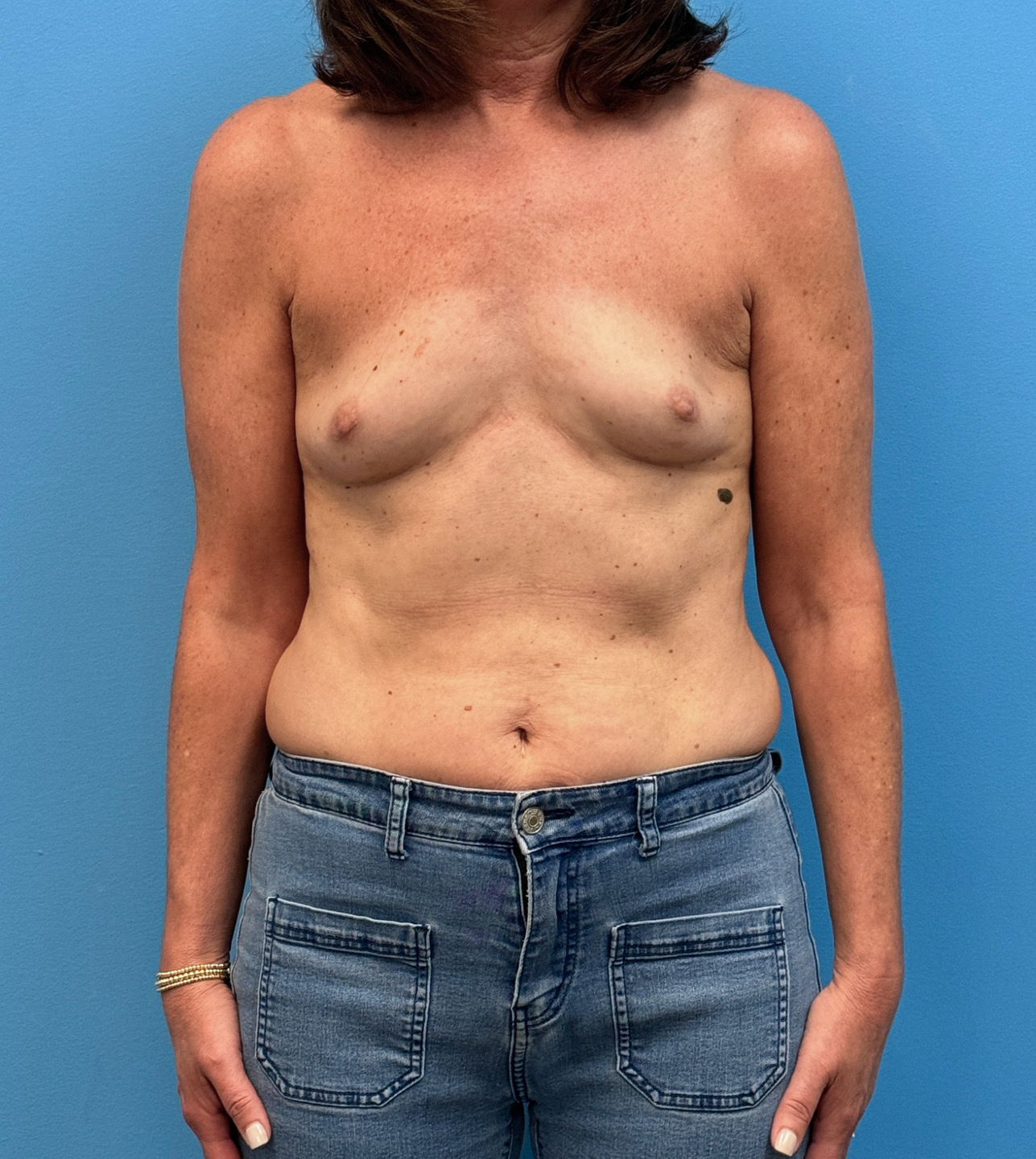 Breast-Reconstruction-Case--28688 | Before Breast 1