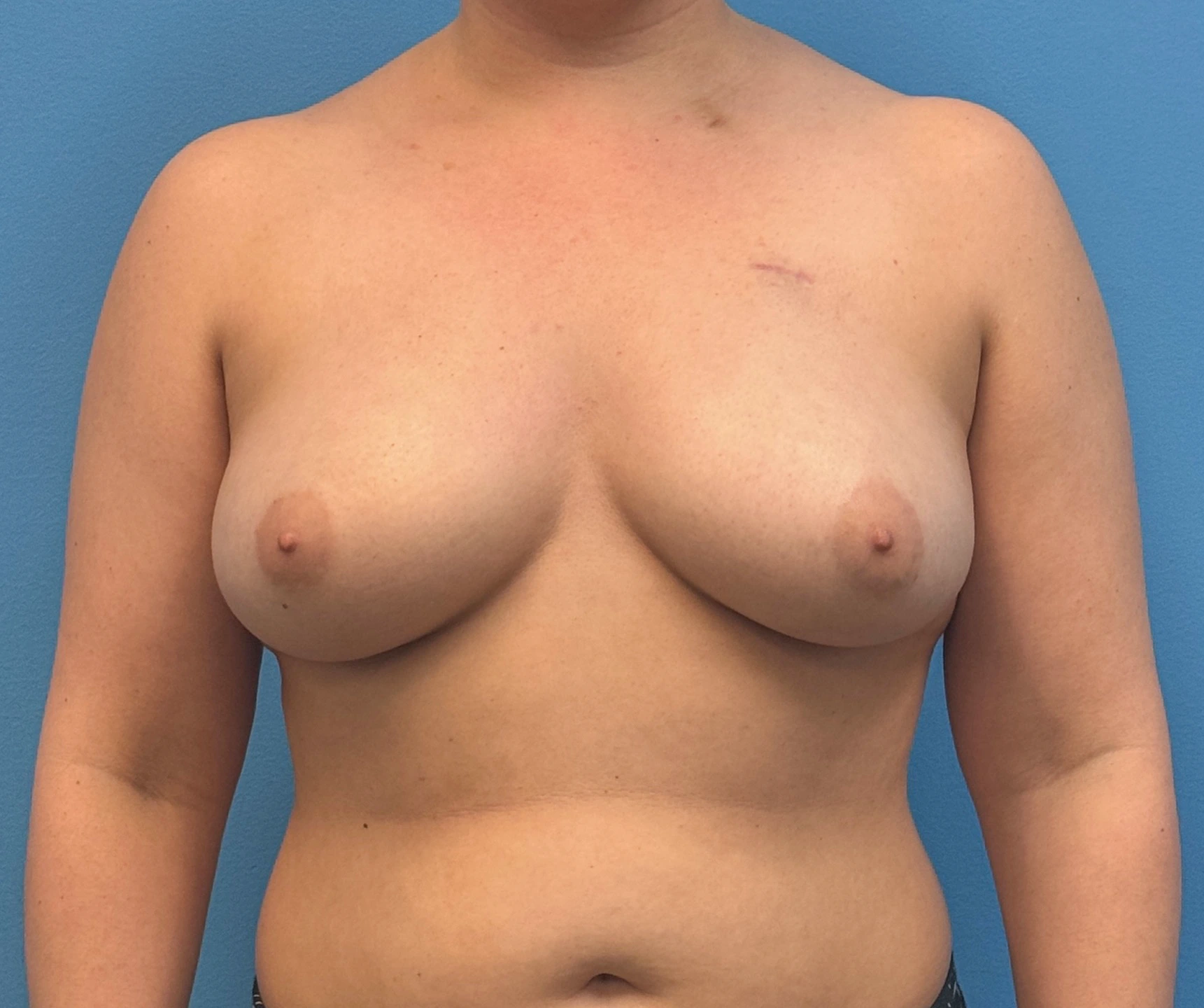 Breast-Reconstruction-Case--28689 | Before Breast 1