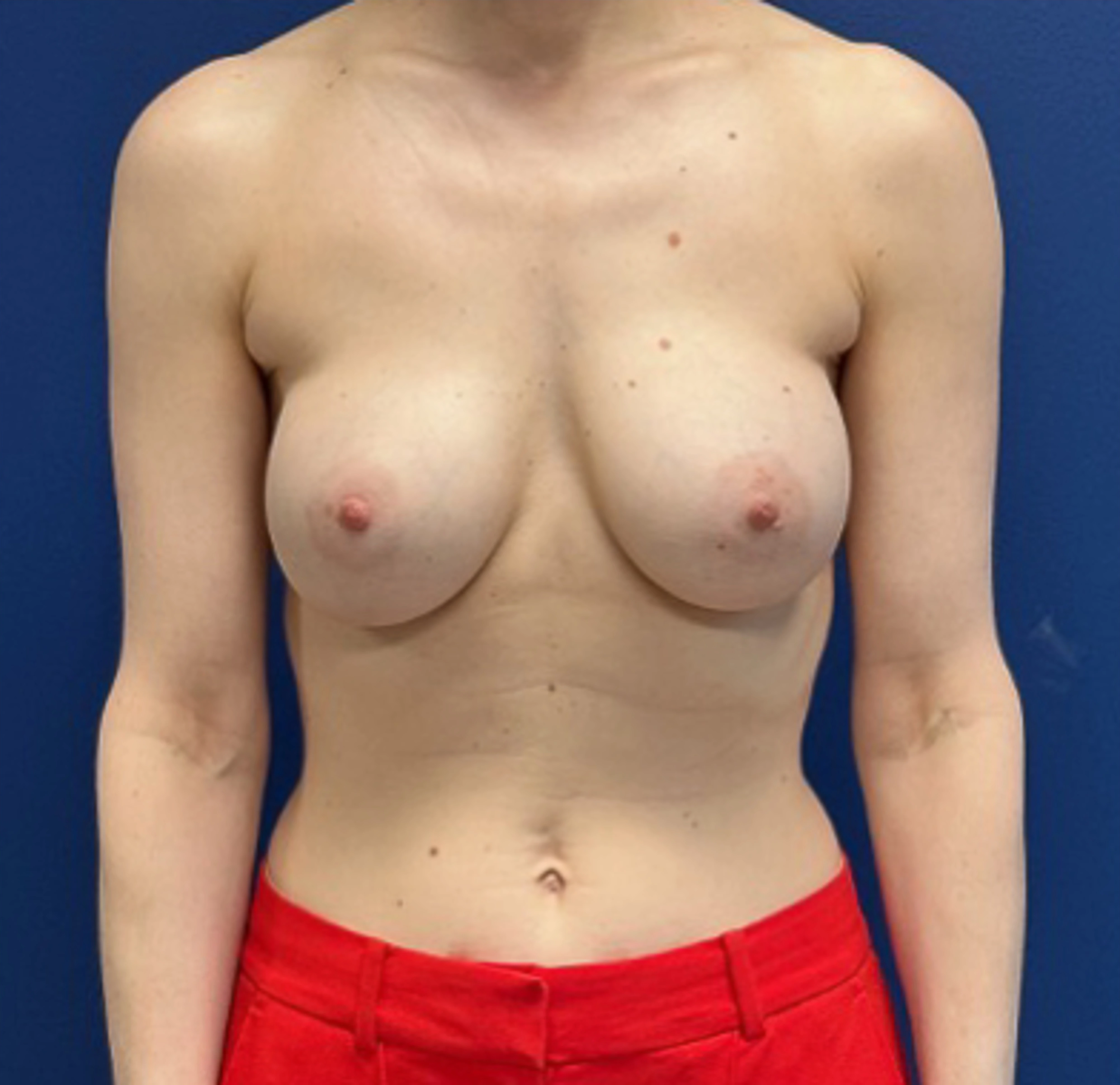 Revision-Augmentation-Case--26939 | Before Breast 1