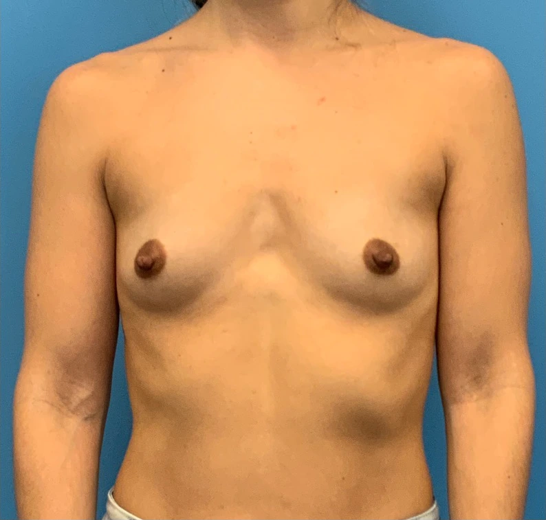Breast-Augmentation-Case--24407 | Before Breast 1