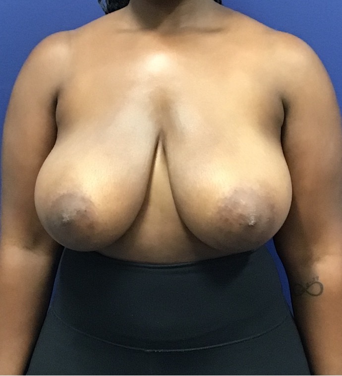 Breast-Reduction-Case--27530 | Before Breast 1