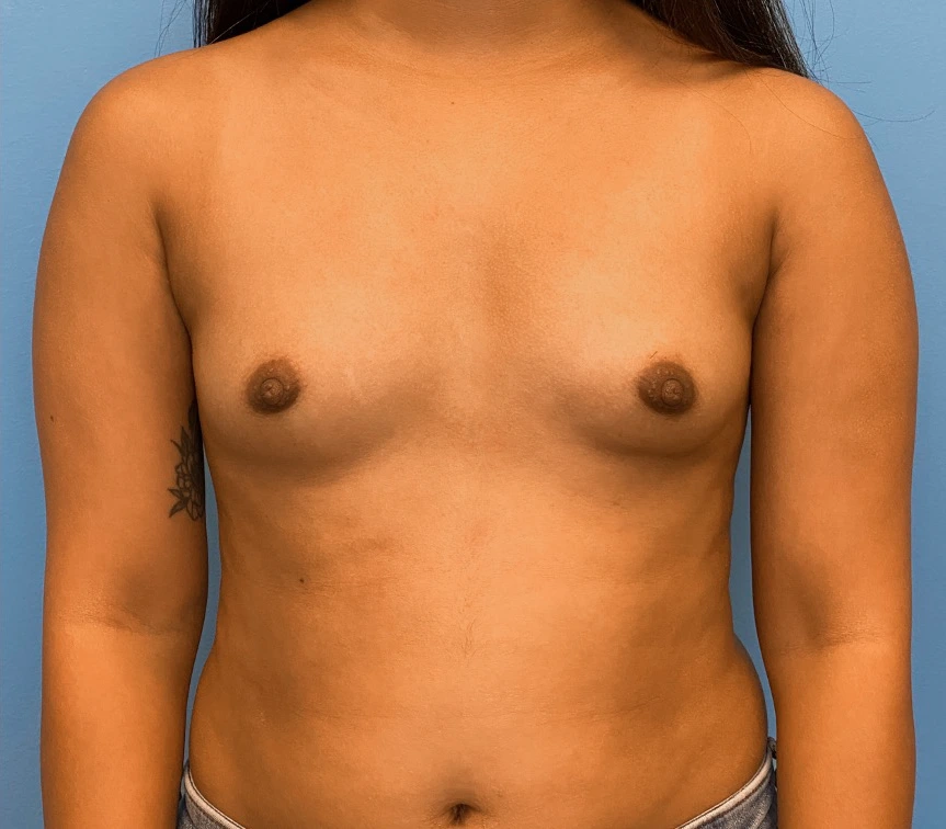 Breast-Augmentation-Case--23834 | Before Breast 1