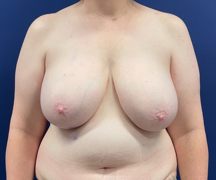 Breast-Reconstruction-DIEP-Flap-Case--26029 | Before Breast 1