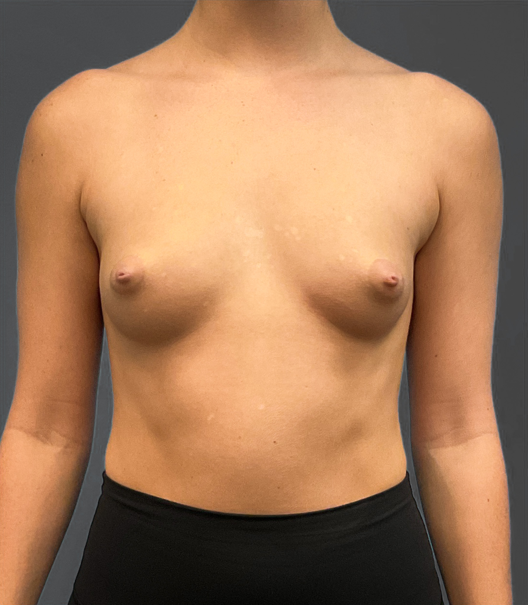 Breast-Augmentation-Case--2384 | Before Breast 1
