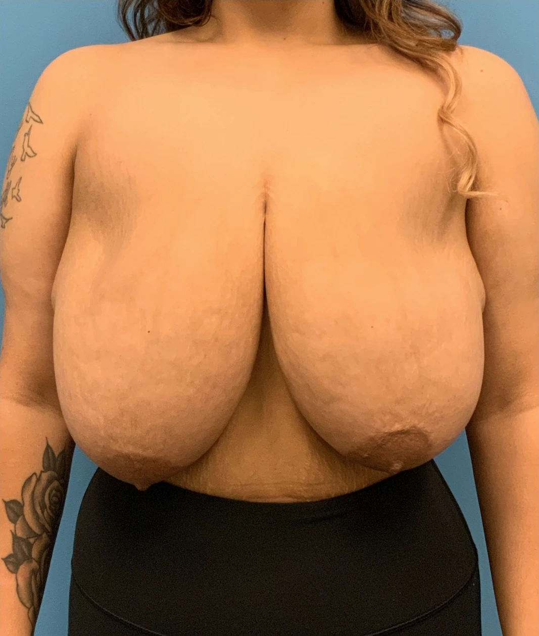 Breast-Reduction-Case--212 | Before Breast 1