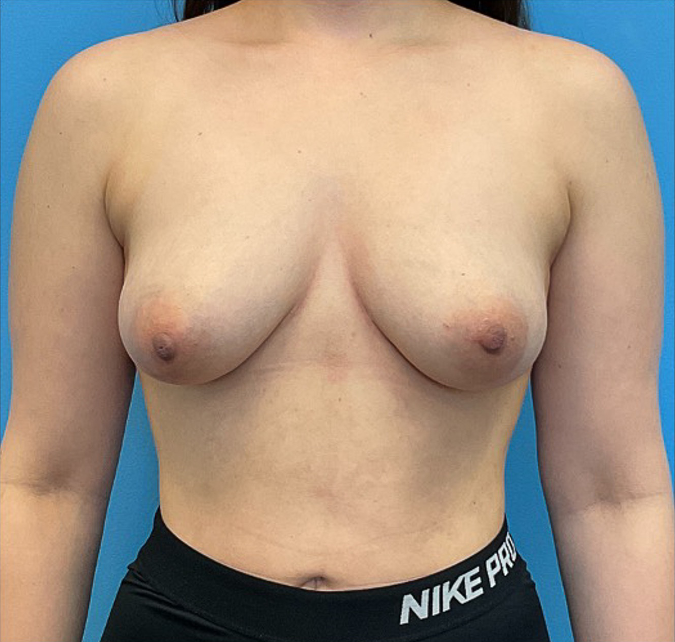 Breast-Augmentation-Case--23631 | Before Breast 1