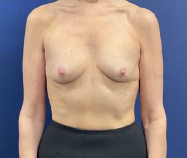 Subfascial-Breast-Augmentation-Case--26649 | Before Breast 1