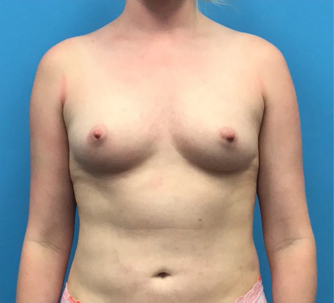 Breast-Augmentation-Case--219 | Before Breast 1