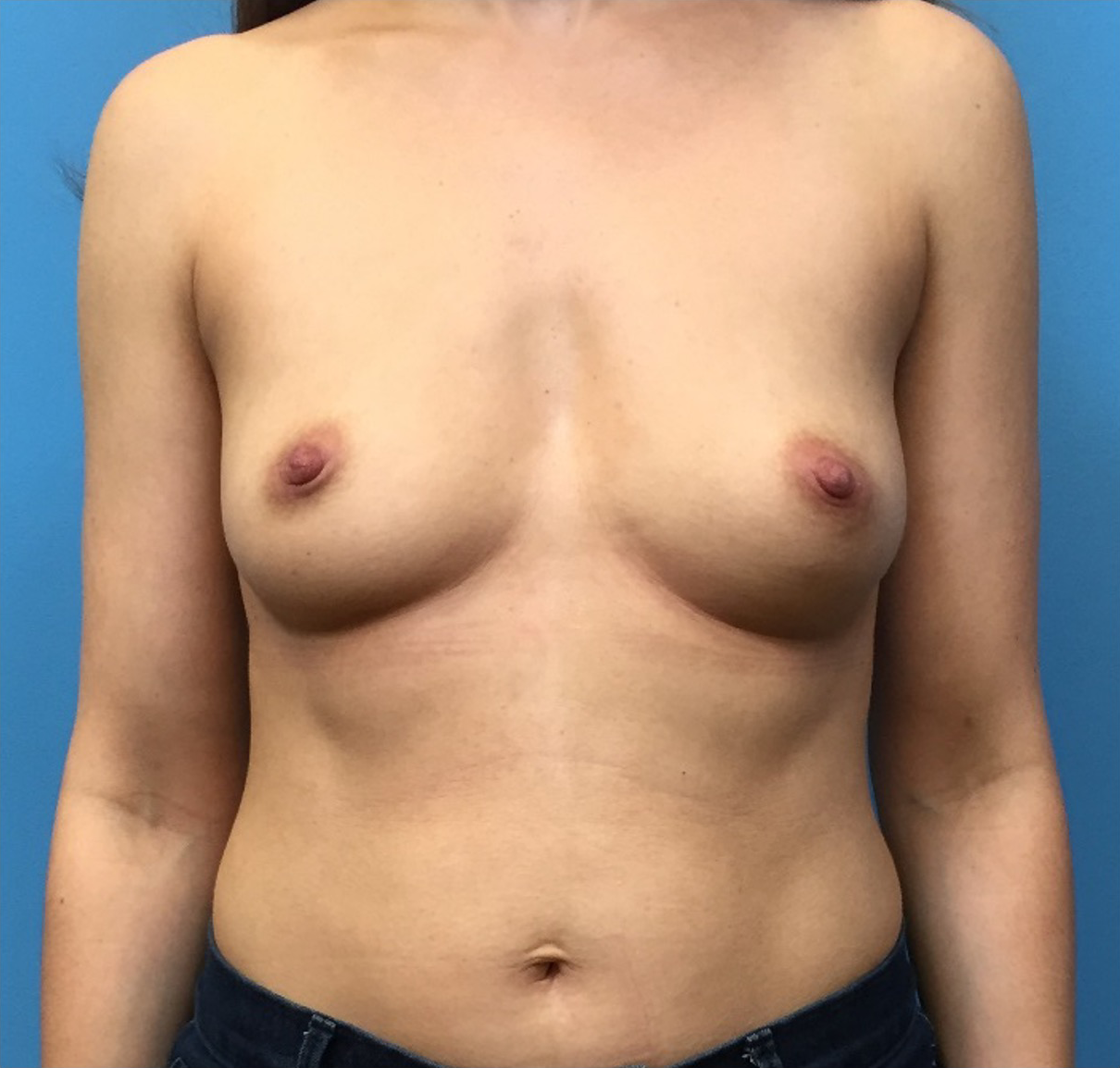Breast-Augmentation-Case--226 | Before Breast 1