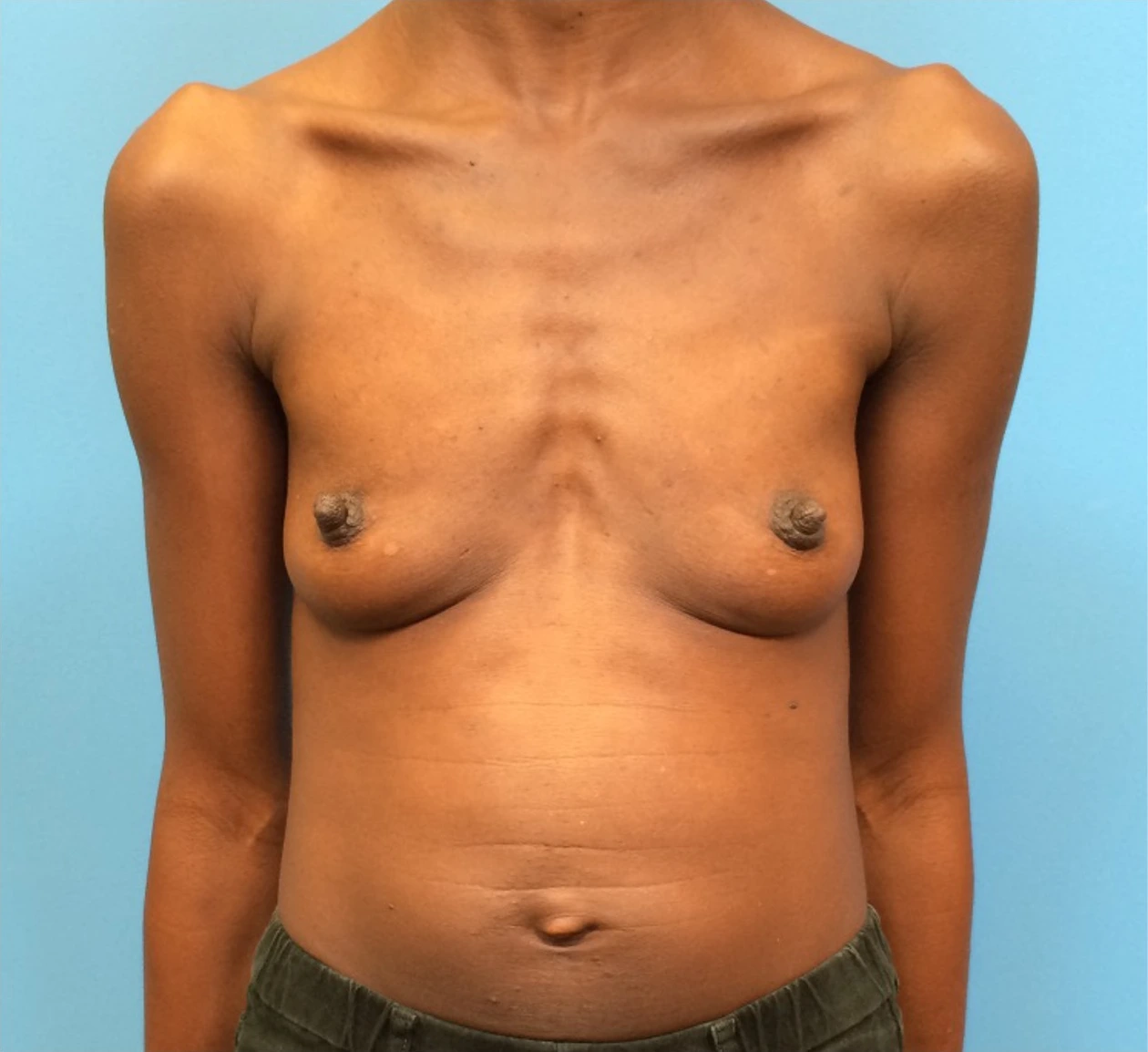 Case--97 | Before Breast 1