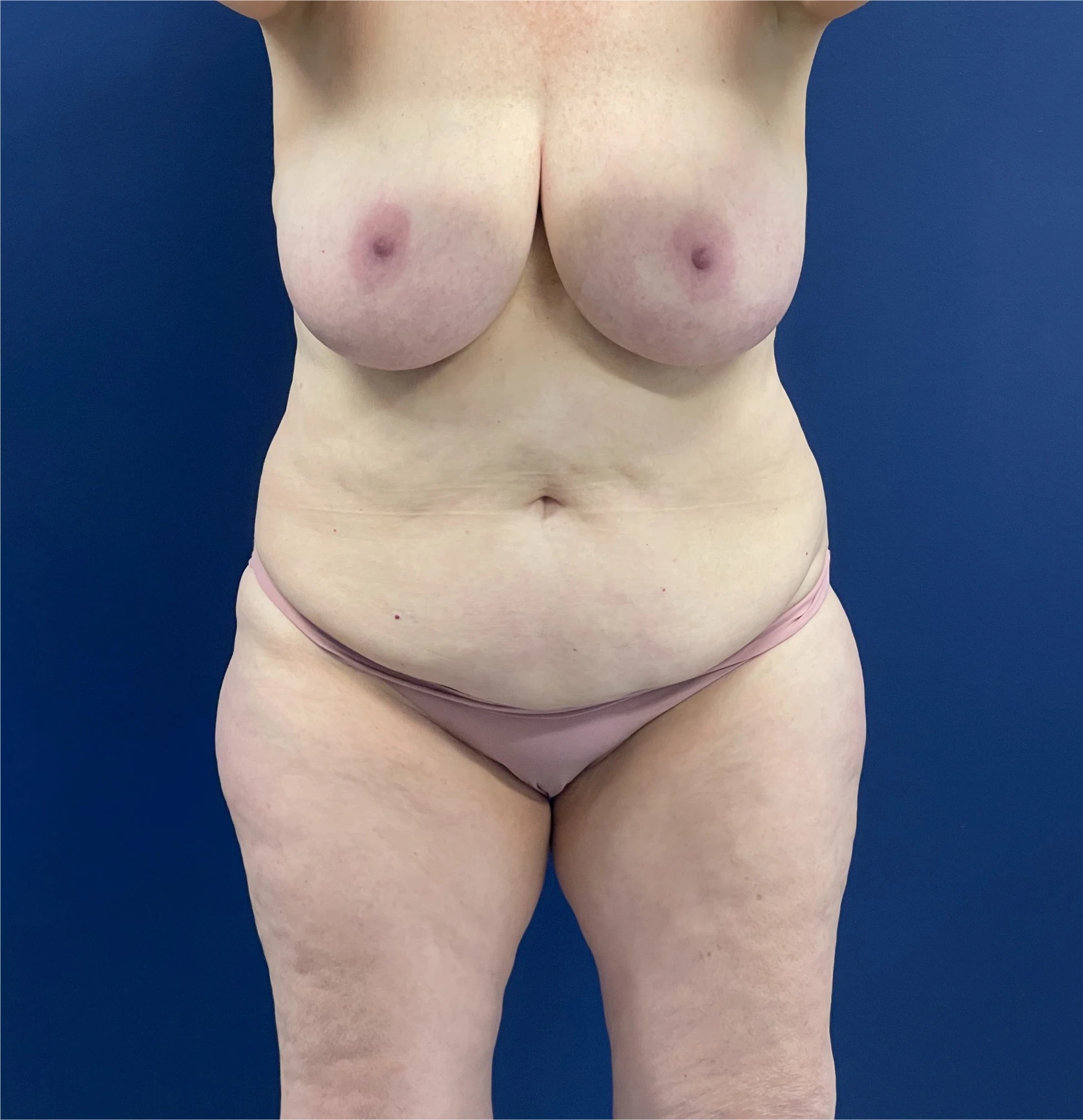 Mommy-Makeover-Case--26853 | Before Mommy Makeover 1