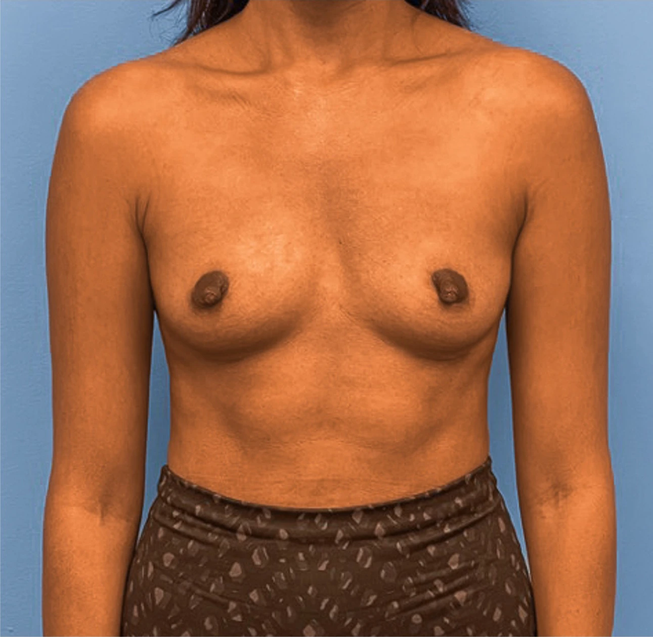 Breast-Augmentation-Case--25592 | Before Breast 1