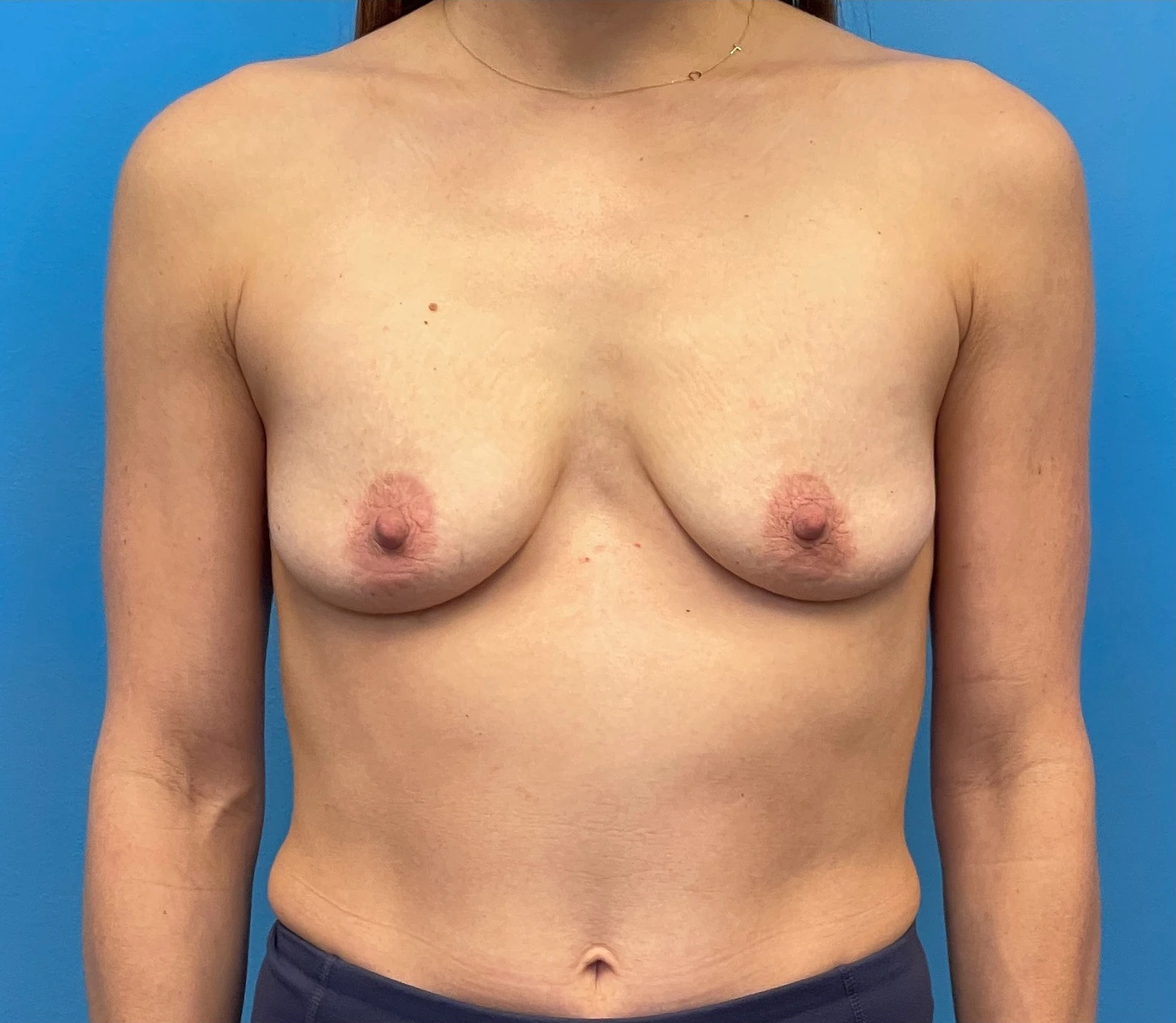 Breast-Augmentation-Mastopexy-Case--25025 | Before Breast 1