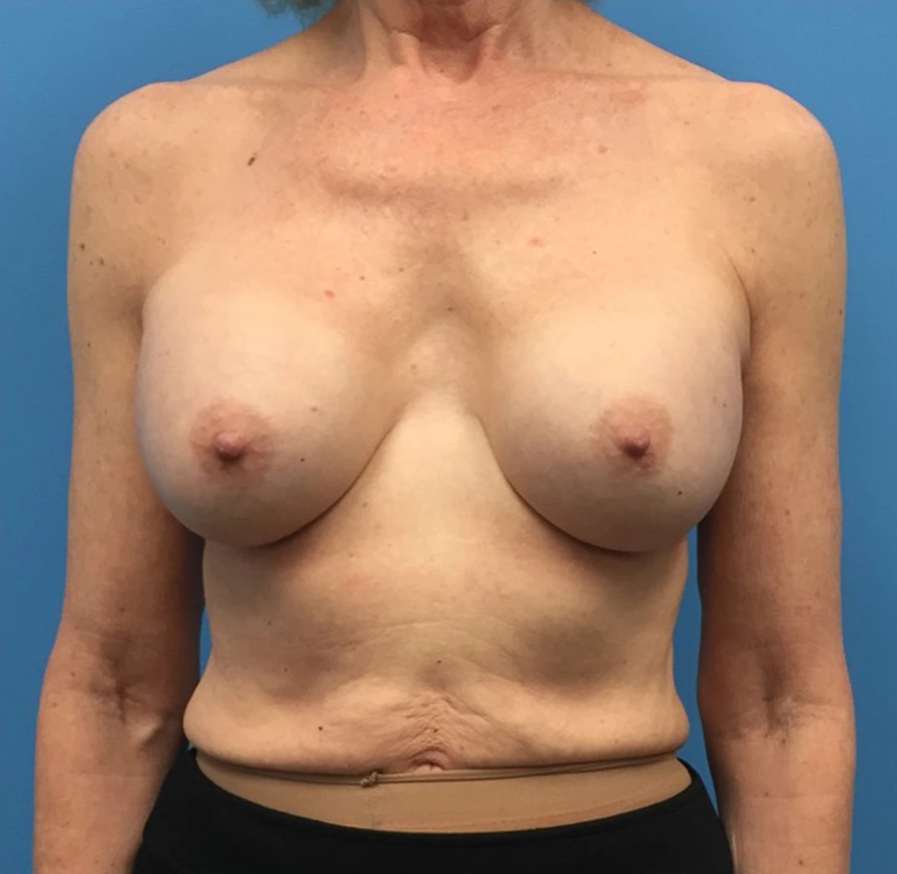 Revision-Breast-Augmentation-Case--237 | Before Breast 1