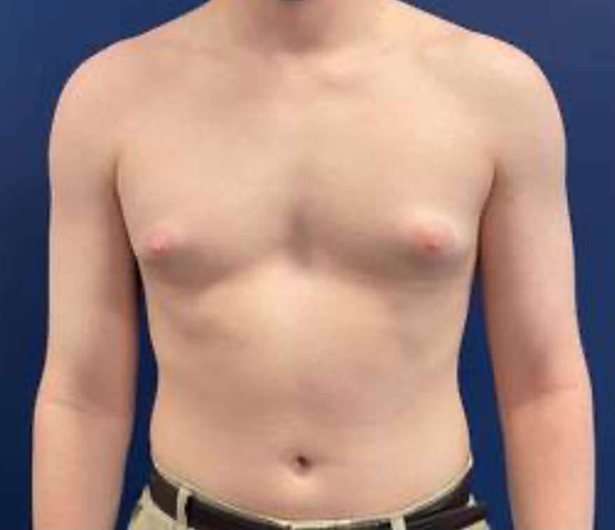 Gynecomastia-Case--214 | Before Breast 1