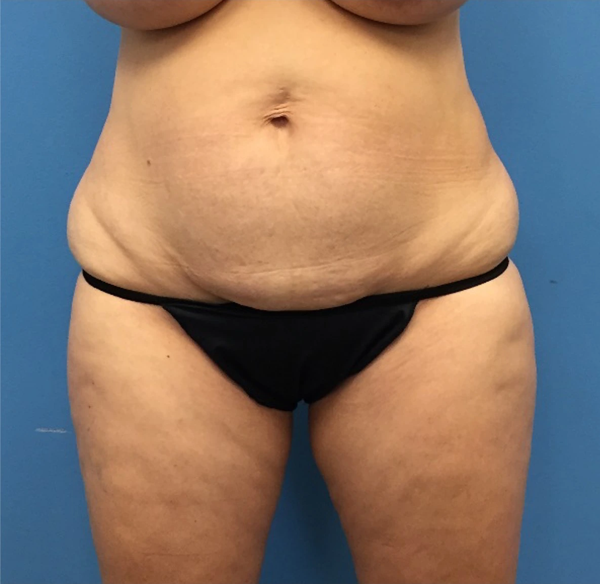 Case--248 | Before Liposuction 1