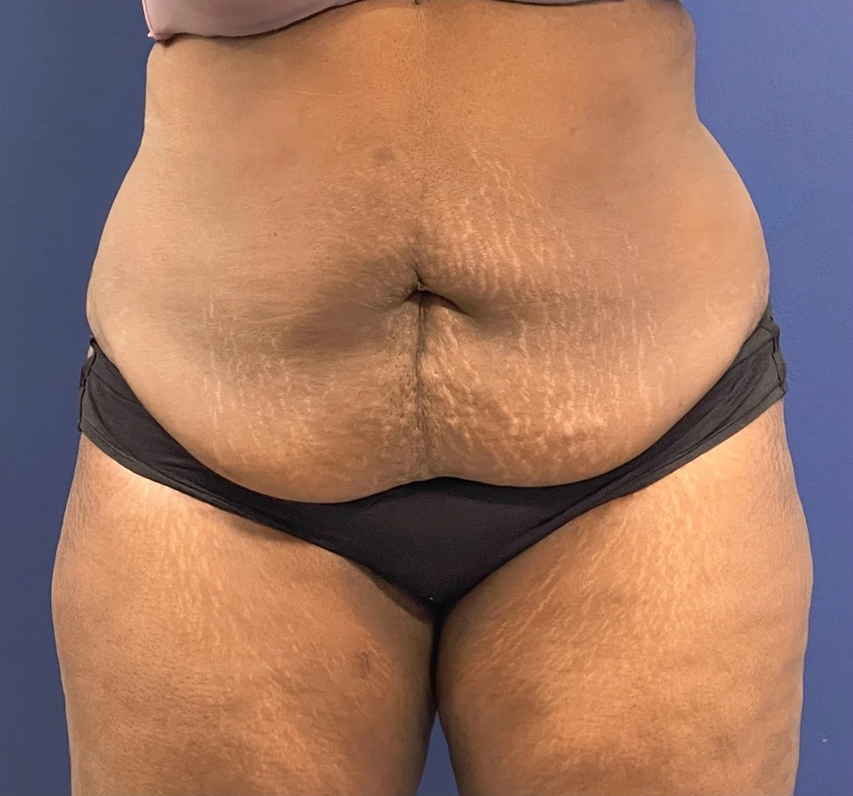 Case--257 | Before Tummy Tuck 1