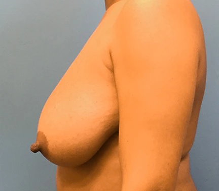 Breast-Reduction-Case--131 | Before Breast 2