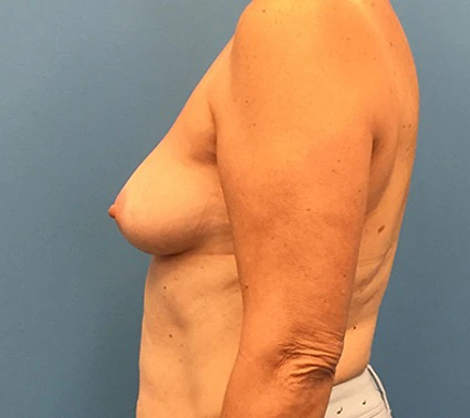 Case--133 | Before Breast 2