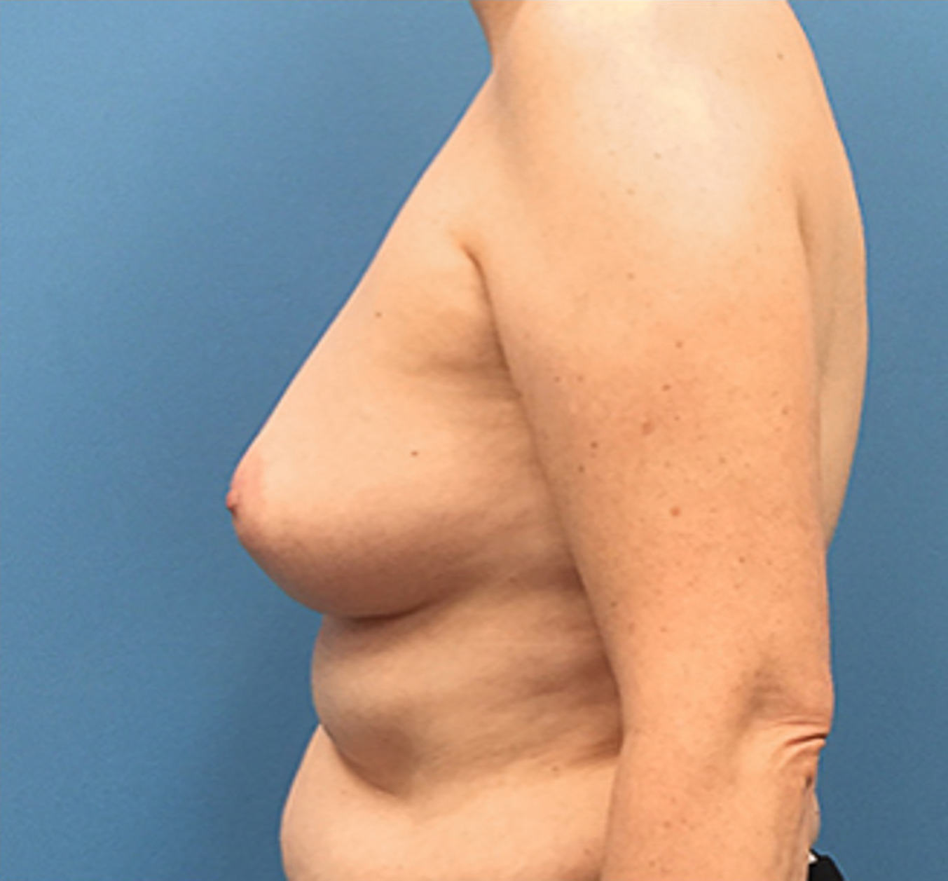 Case--135 | Before Breast 2