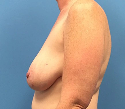Case--137 | Before Breast 2