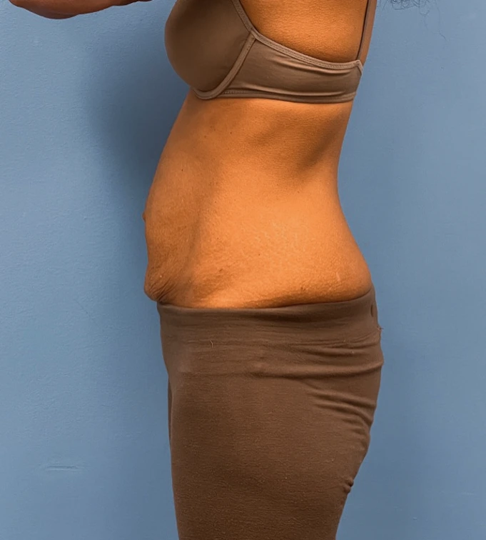 Abdominoplasty-Case--24922 | Before Liposuction 2
