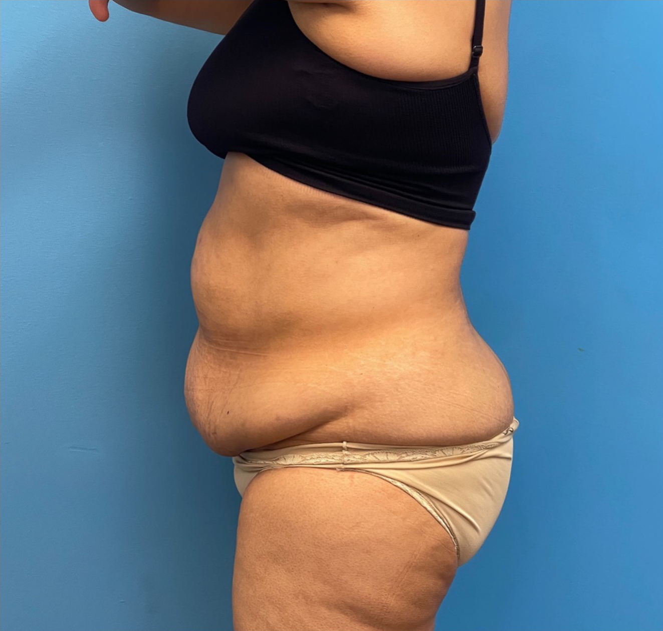 Lipoabdominoplasty-Case--27602 | Before Liposuction 2