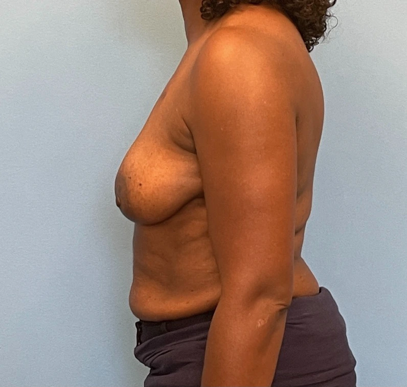 Breast-Reconstruction-Case--23930 | Before Breast 2
