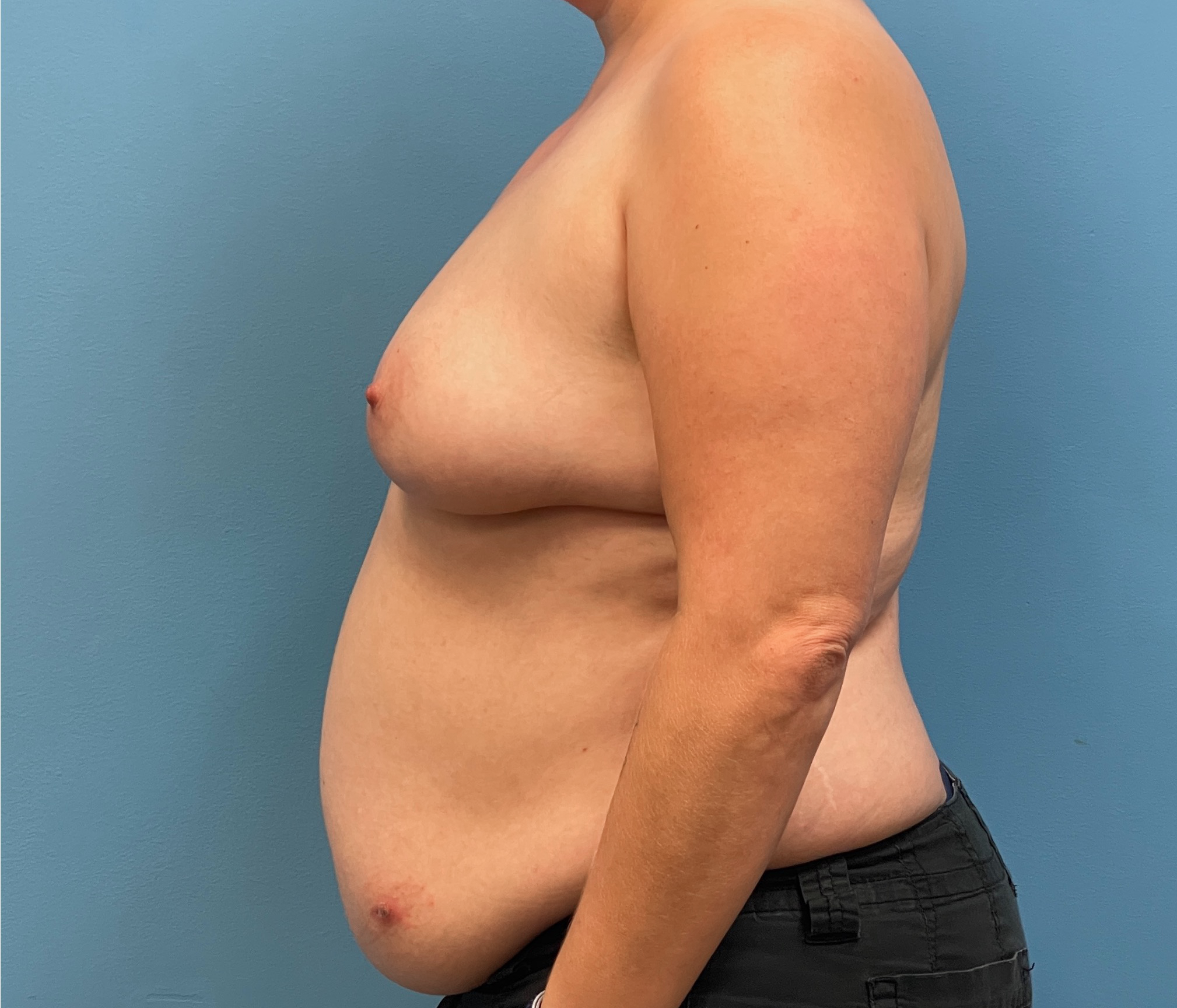 DIEP-Flap-Case--28021 | Before Breast 2