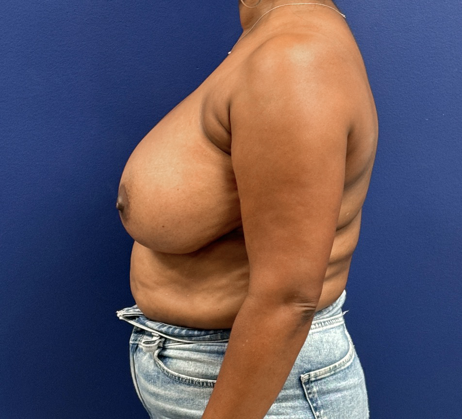 Breast-Reduction-Case--28242 | Before Breast 2