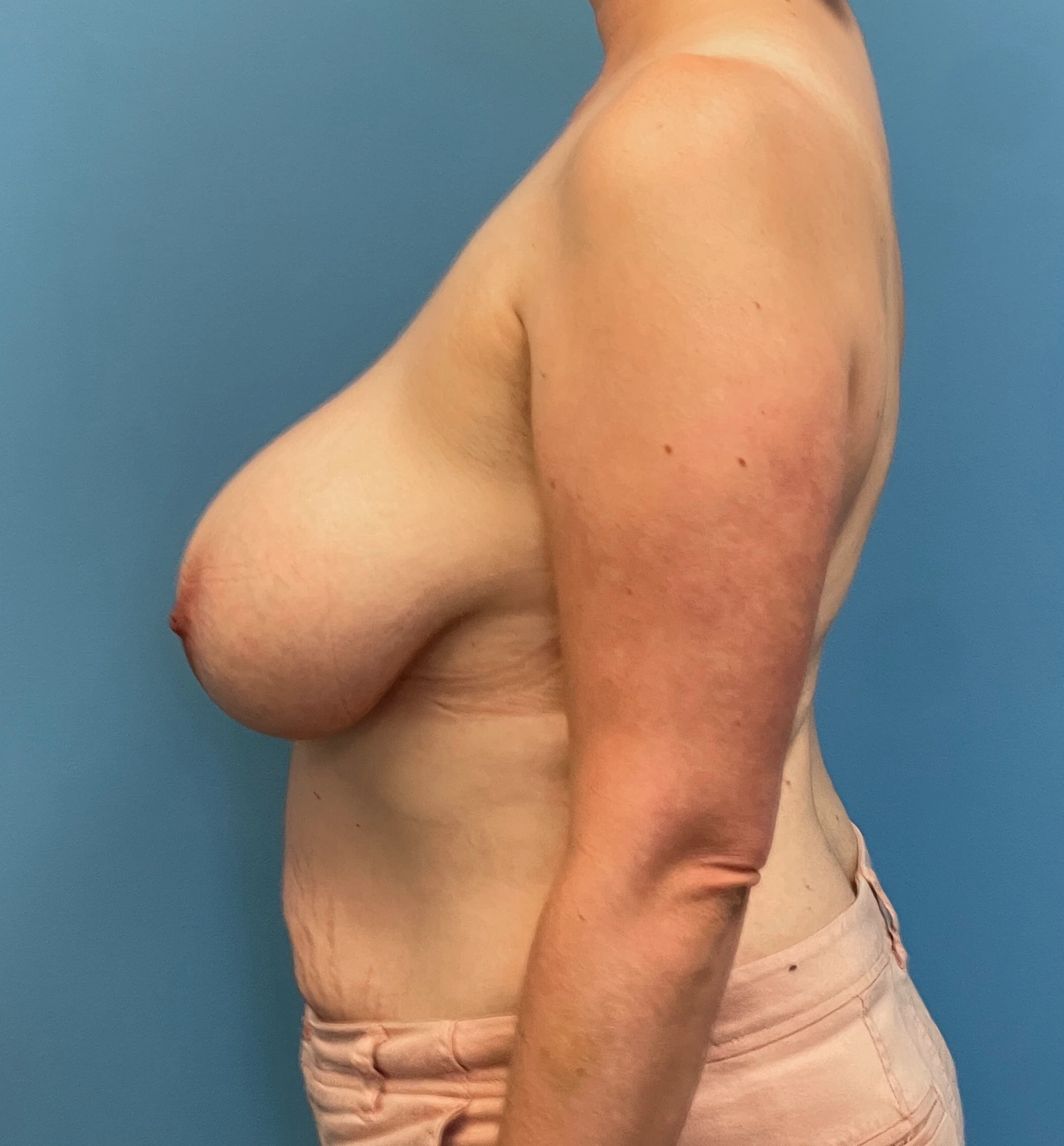 Breast-Reduction-Case--27625 | Before Breast 2